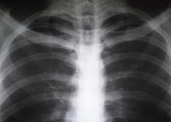 Radiografía pulmonar de un trabajador afectado por silicosis debido a la exposición al polvo de sílice en encimeras de piedra artificial.