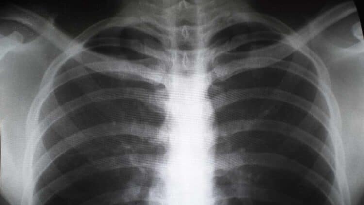 Radiografía pulmonar de un trabajador afectado por silicosis debido a la exposición al polvo de sílice en encimeras de piedra artificial.