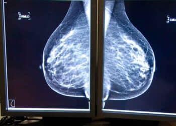 Mamografía digital en dos monitores médicos que muestra ambas mamas durante una prueba de detección de cáncer