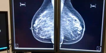 Mamografía digital en dos monitores médicos que muestra ambas mamas durante una prueba de detección de cáncer
