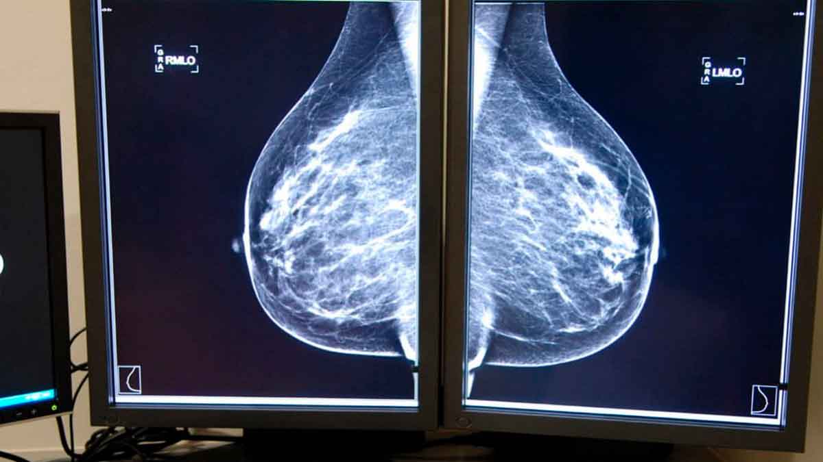 Mamografía digital en dos monitores médicos que muestra ambas mamas durante una prueba de detección de cáncer