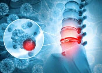 Ilustración de lesión medular: columna vertebral con disco dañado y detalle de células nerviosas.