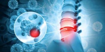 Ilustración de lesión medular: columna vertebral con disco dañado y detalle de células nerviosas.