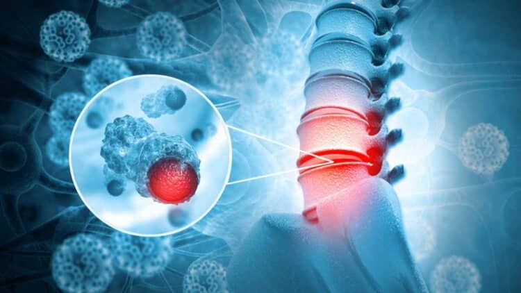 Ilustración de lesión medular: columna vertebral con disco dañado y detalle de células nerviosas.
