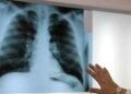 Radiografía de pulmones afectados por exposición al amianto en trabajadores con incapacidad permanente.