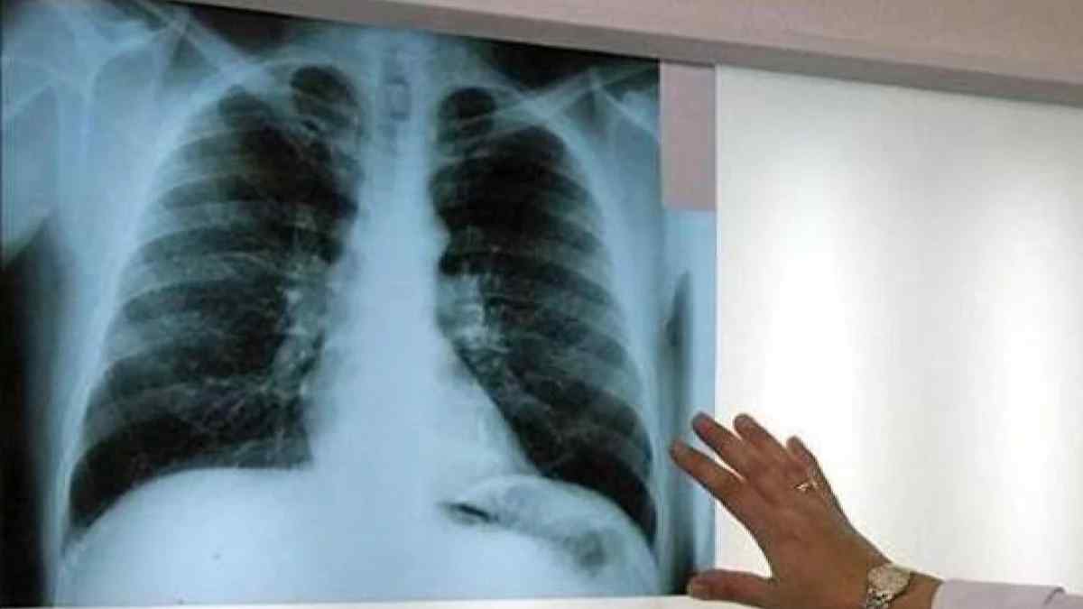 Radiografía de pulmones afectados por exposición al amianto en trabajadores con incapacidad permanente.