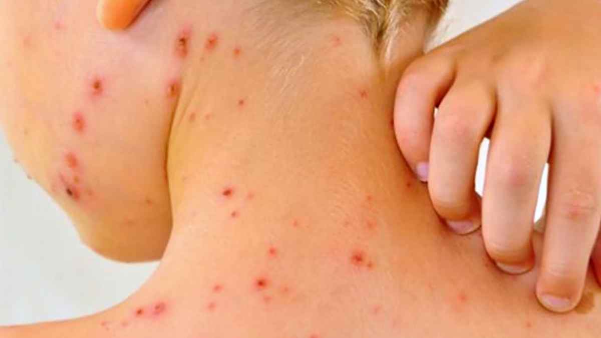 niño con sarampión y erupción en la piel síntomas visibles vacunación infantil